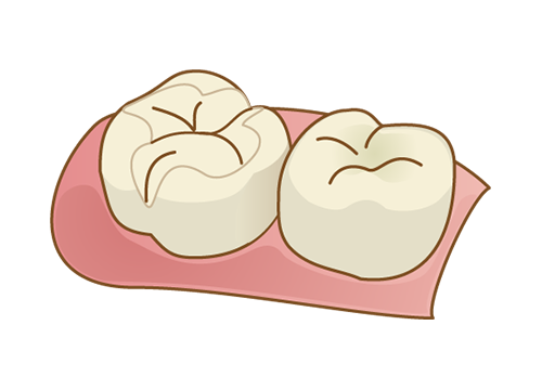 オールセラミック