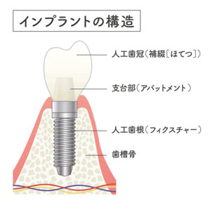インプラント